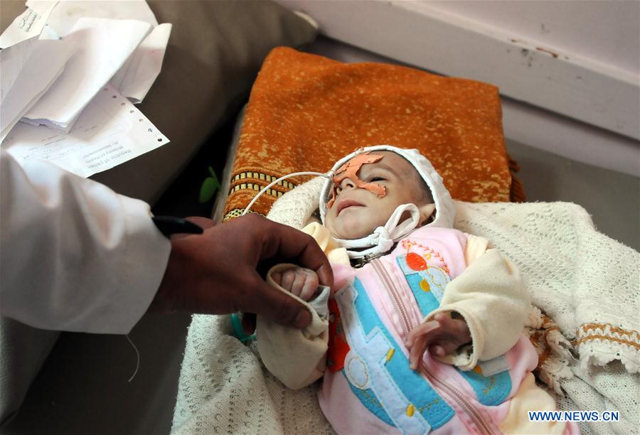 YEMEN-SANAA-CHILDREN-MALNUTRITION